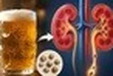 Uống bia giúp đào thải sỏi thận?