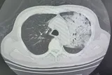 Cụ ông 70 tuổi phổi gần như "trắng xóa", bác sĩ chỉ rõ thói quen "cực độc" khi dùng điều hoà
