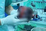 Đau bụng tưởng nhẹ, người đàn ông "sốc nặng" khi phát hiện thứ "đáng sợ" to bằng quả dưa lưới