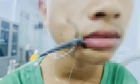 Bé trai 15 tuổi đau dữ dội vùng má, bác sĩ lấy ra thứ "đáng sợ" bên trong