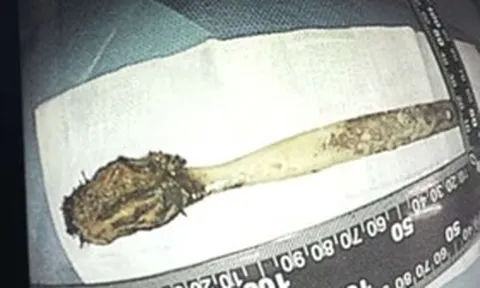 Đau bụng đi khám, người đàn ông "sốc" phát hiện bàn chải nằm trong bụng 52 năm