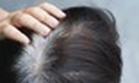 Người trẻ tóc bạc sớm: Bác sĩ chỉ ra 3 dưỡng chất hay bị thiếu hụt, ít người để ý đến