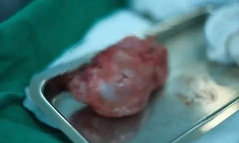 Bé 10 ngày tuổi bụng phình to, kết quả thăm khám khiến gia đình bàng hoàng