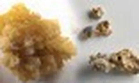 Vì sao sỏi thận có viên tròn nhẵn, viên lại sắc nhọn như san hô?