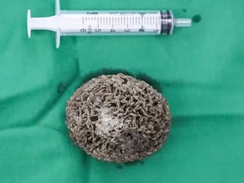 Người đàn ông 50 tuổi đau hạ vị kéo dài, bác sĩ sốc khi gắp ra thứ "đáng sợ" bằng quả trứng ngỗng