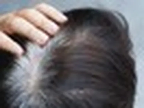 Người trẻ tóc bạc sớm: Bác sĩ chỉ ra 3 dưỡng chất hay bị thiếu hụt, ít người để ý đến