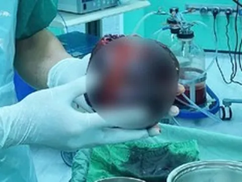 Đau bụng tưởng nhẹ, người đàn ông "sốc nặng" khi phát hiện thứ "đáng sợ" to bằng quả dưa lưới