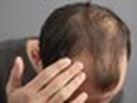 Thường xuyên ăn 5 món này, đừng trách vì sao tóc rụng lả tả