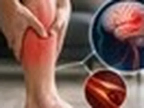 Chuyên gia cảnh báo: 5 dấu hiệu tại BẮP CHÂN có thể là tín hiệu cảnh báo đột quỵ, nếu thấy phải đi kiểm tra ngay